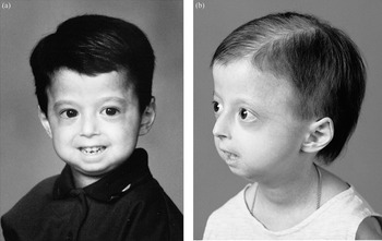 Foto ilustrasi penderita Progeria yang menunjukkan ciri khas penuaan dini